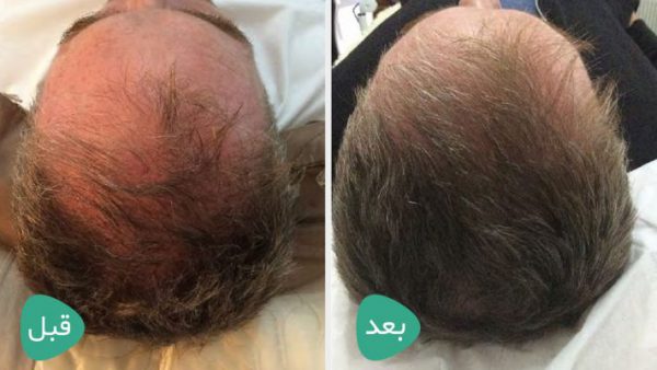 کوکتل احیا مو فیوژن